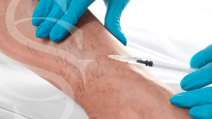 gilmar-santos-tratamentos-escleroterapia Imagem Tratamentos de Vasinhos e Varizes